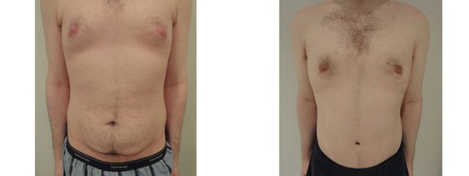 27 Year Old Male - Tummy Tuck Surgery