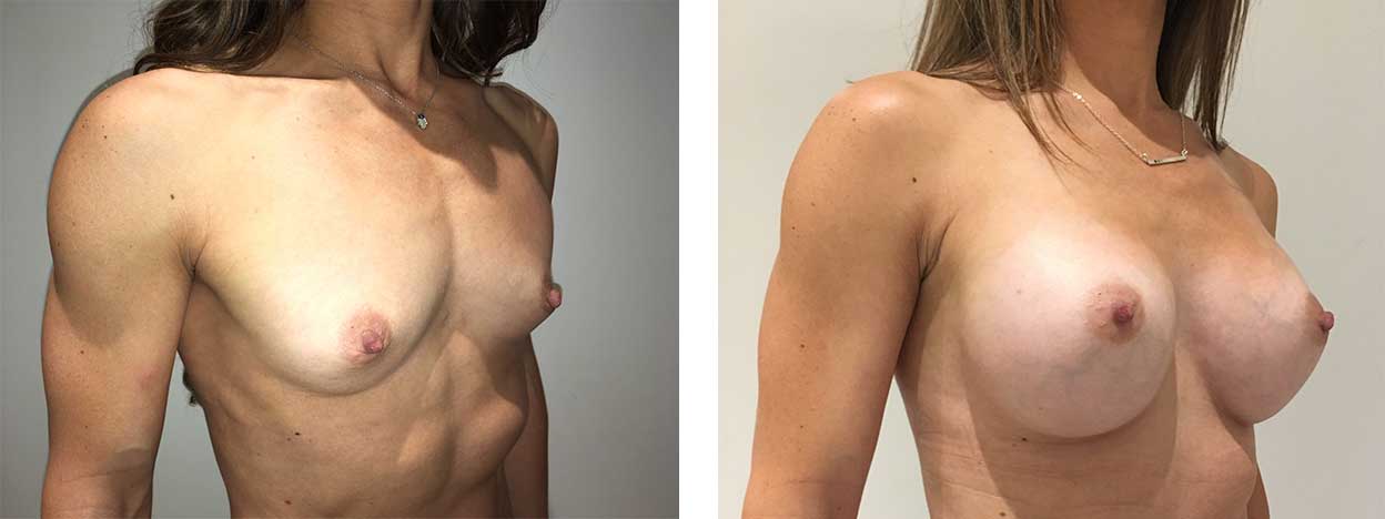 33 Year Old Female - Breast Augmentation